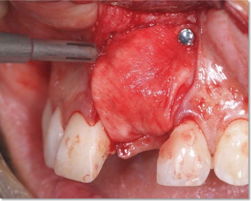 image guided bone regeneration